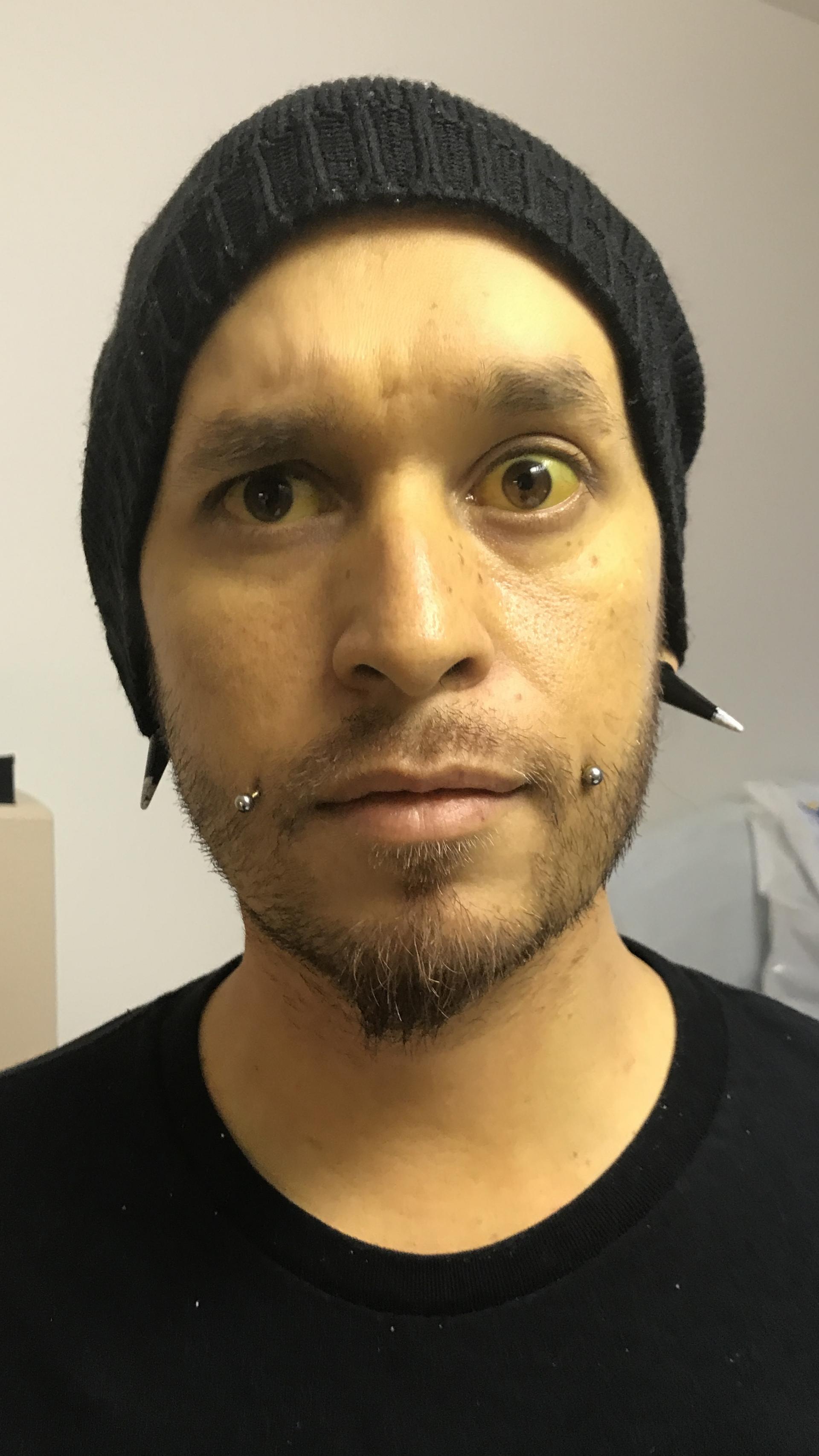 Kohdi Rayne in 2017 — stage 4 cirrhosis, given seven days to live
