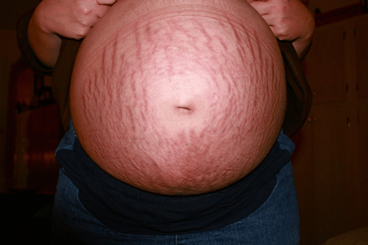 photo of pregnancy bump with lots of stretch marks