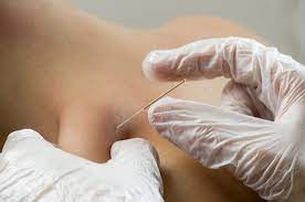 Dry needling NJ