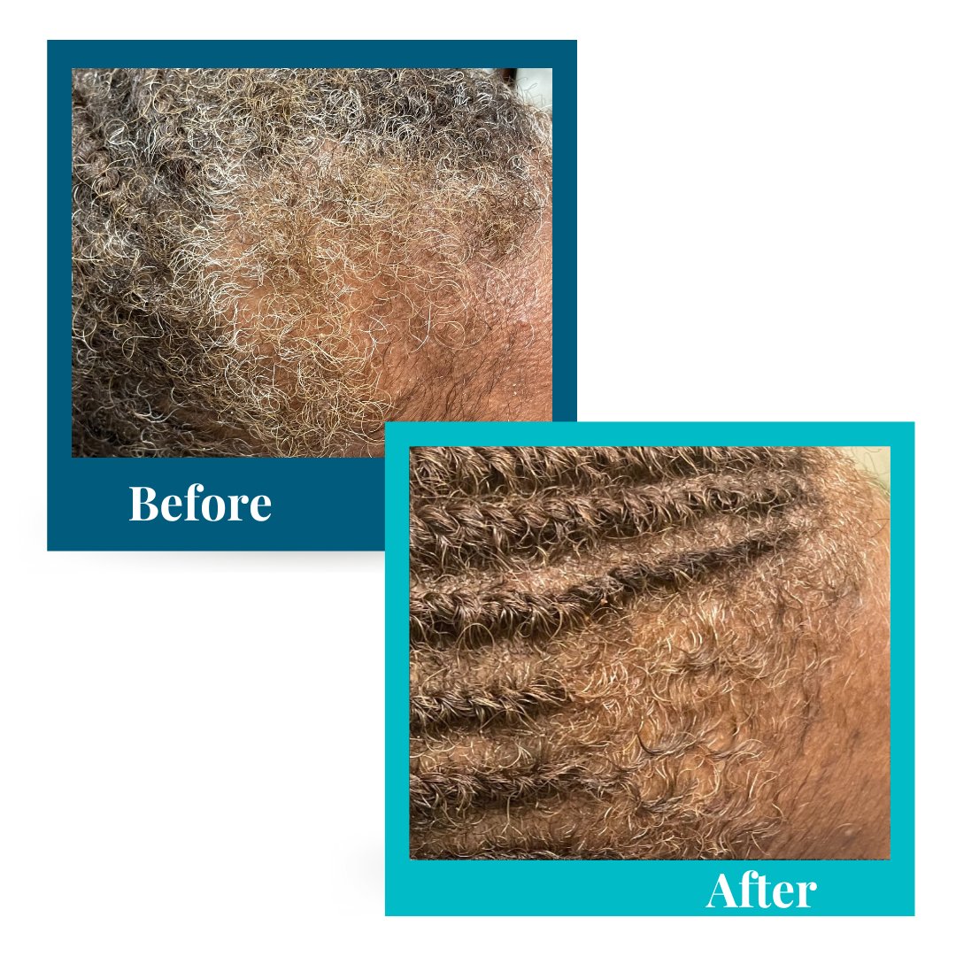 temple hair loss, hormonal hair loss treatment