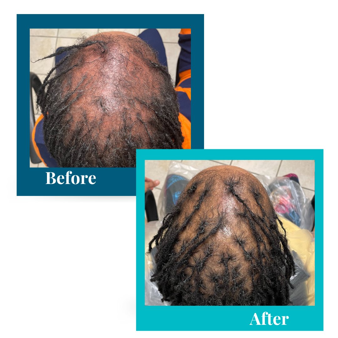 sister loc hair thinning, alopecia treatment for women