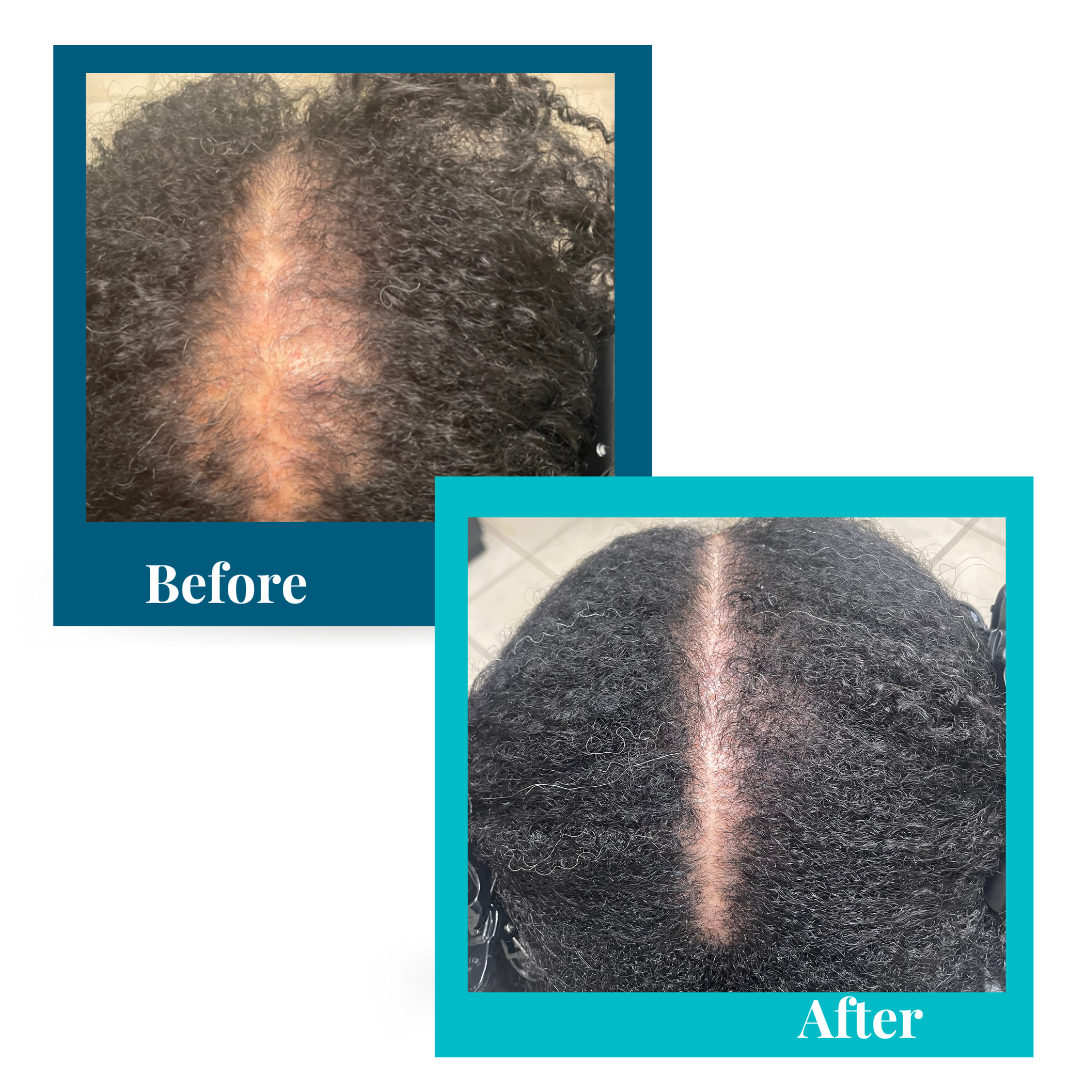 female crown hair loss, CCCA hair regrowth
